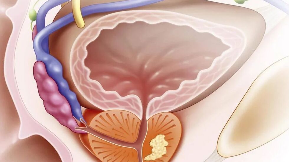 Chronic prostatitis nebacaterial