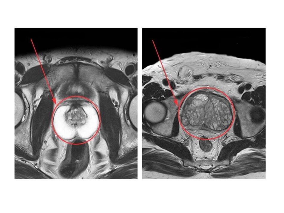 Comparison between a healthy prostate (left) and an inflamed one (right) on MRI images