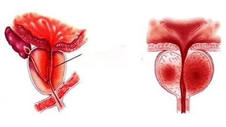What a chronic prostatitis does